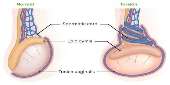 Testicular Torsion