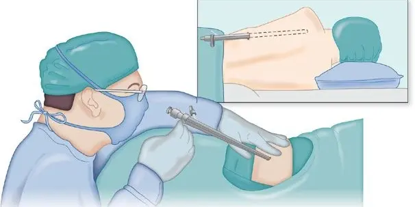 Thoracic Surgery Procedures