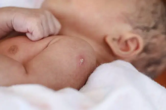 Tuberculosis (BCG) Vaccine for Babies in Dubai