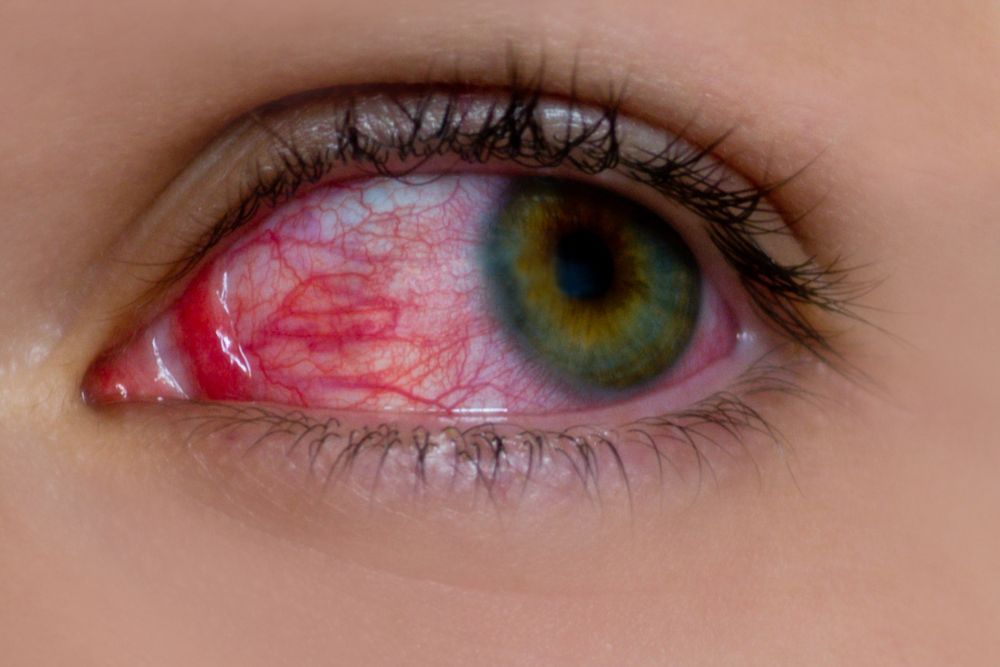 Uvietis Treatment