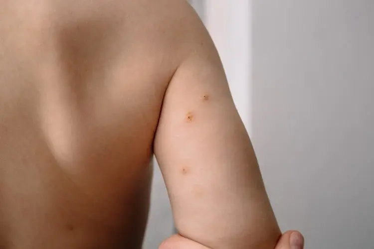 Warts and Molluscum Children Treatment