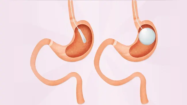 Weight-Loss Injections, Gastric Balloon or Surgery: How Do They Compare?