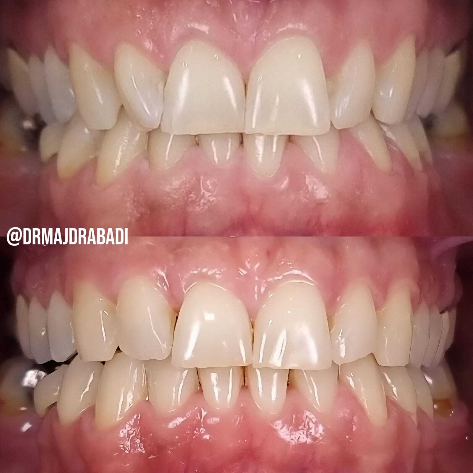 Invisalign Aligners Dubai