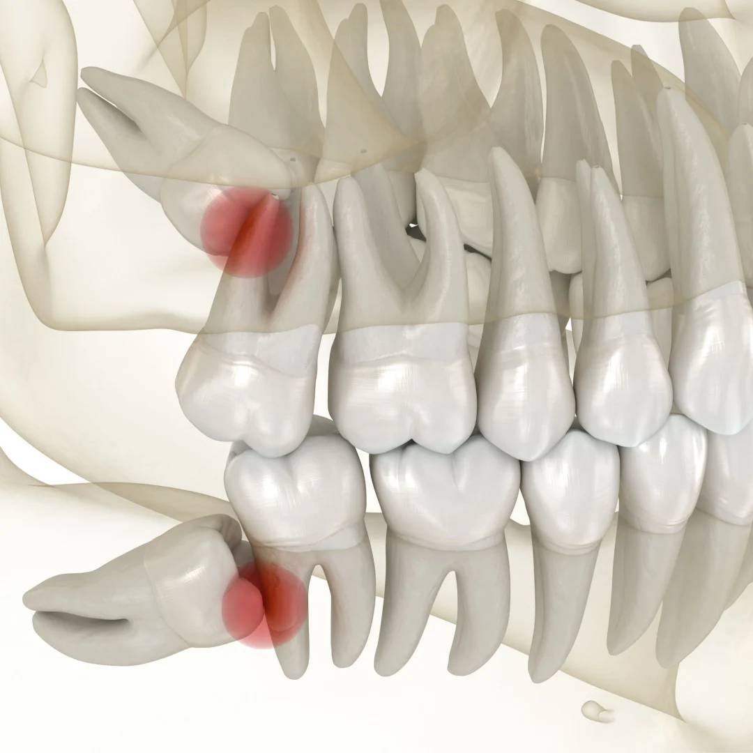 Wisdom tooth removal