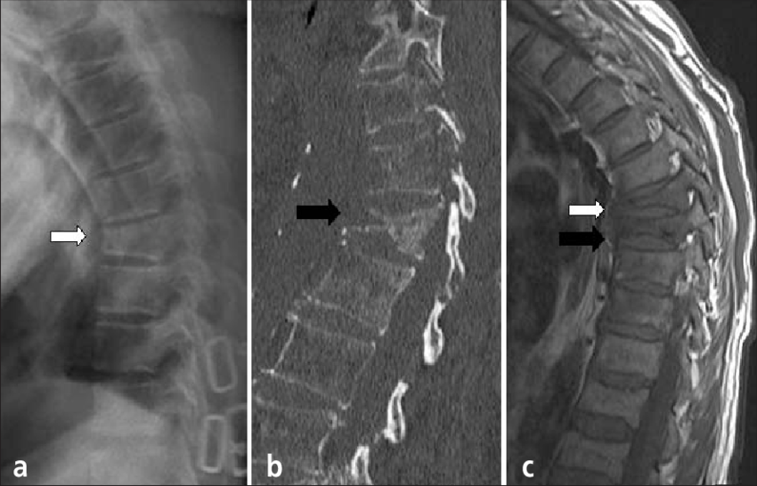 Spine Fractures