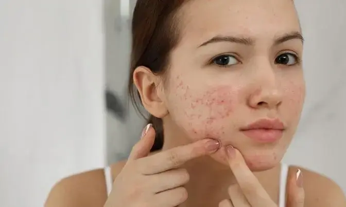 Acne Scars Treatment Dubai