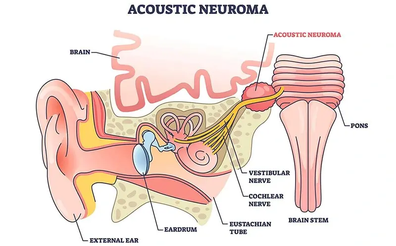 Acoustic Neuroma