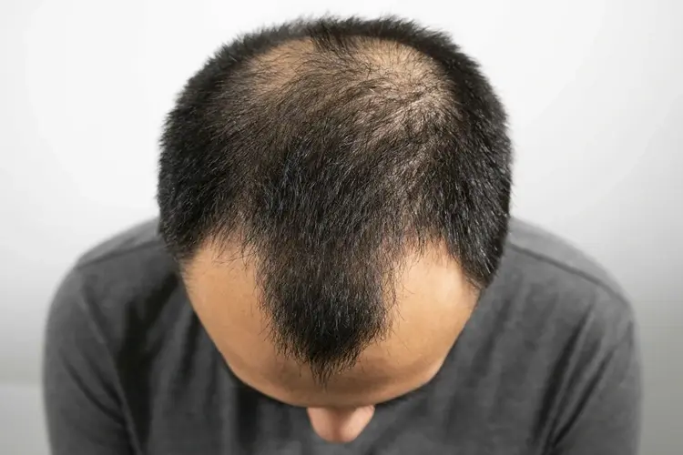 Androgenetic Alopecia Dubai
