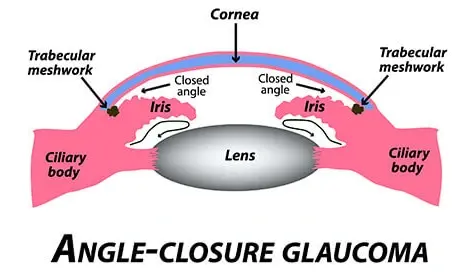 Angle-Closure Glaucoma