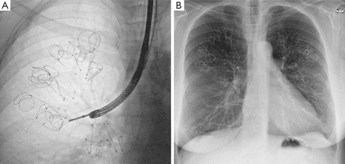 Endobronchial Coil 
