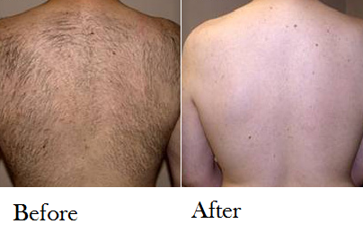Laser Hair Removal