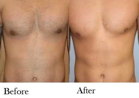 Laser Hair Removal