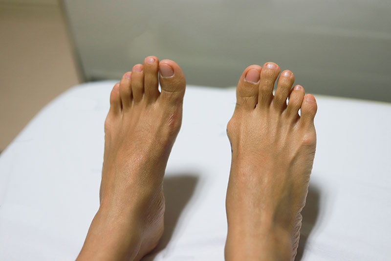 Minimally Invasive Hallux Valgus Correction