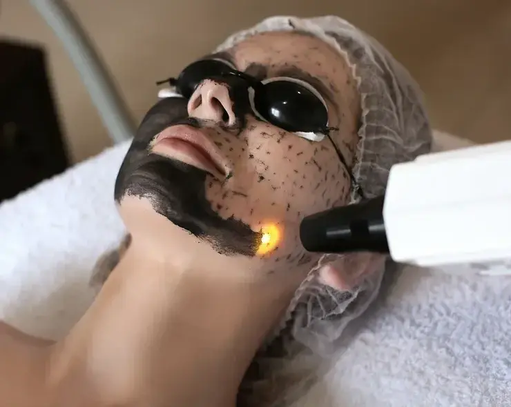 Carbon Laser Peel Treatment in Dubai