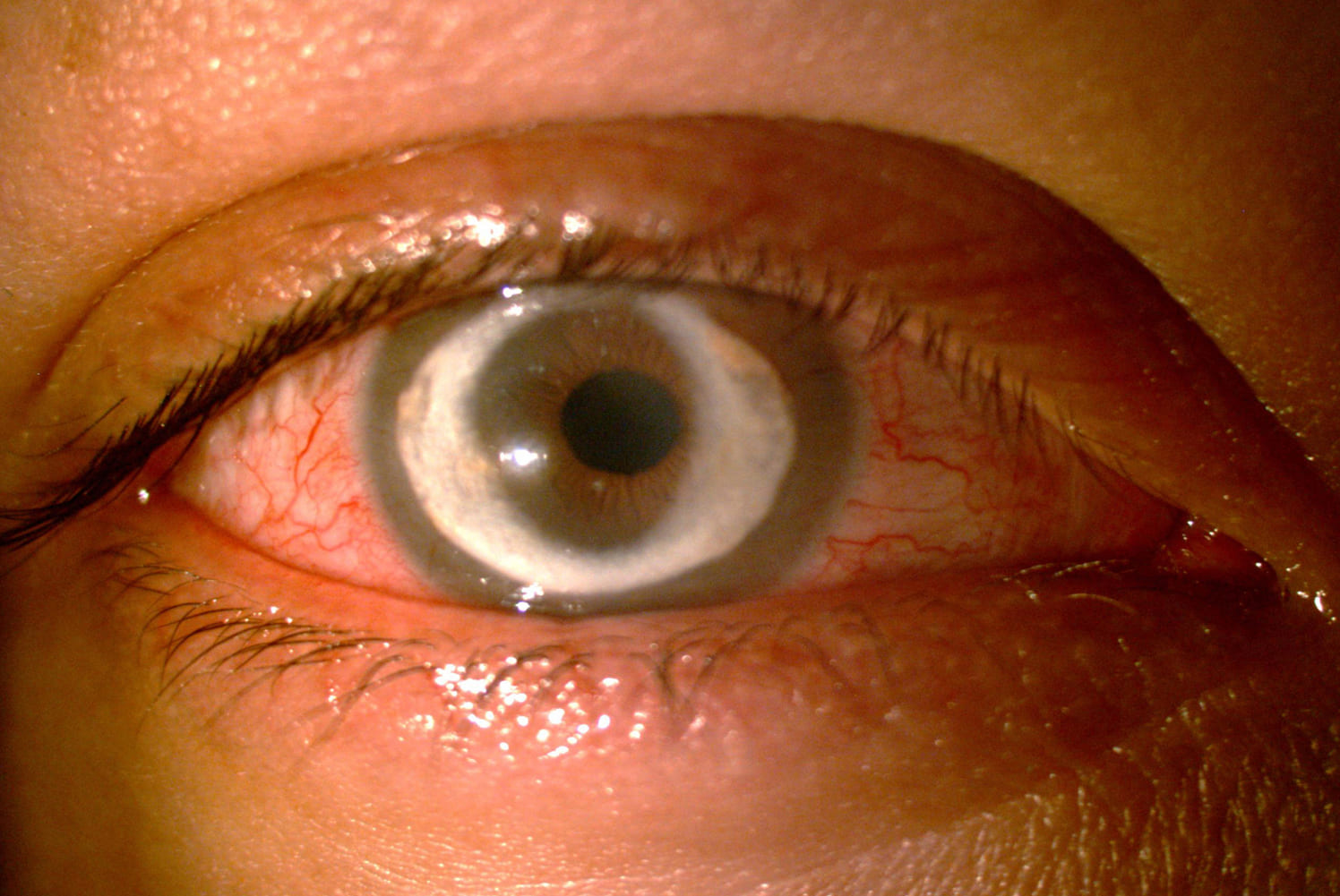 Cogan Syndrome
