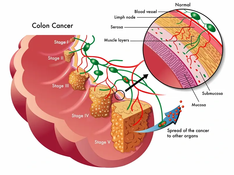 Colon Cancer