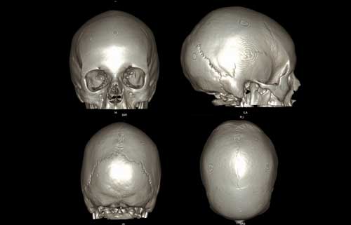 ct_slide_skull_3d0