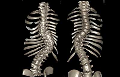 ct_slide_spine_3d_20