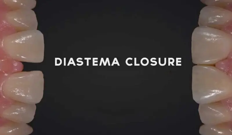 Diastema Closure