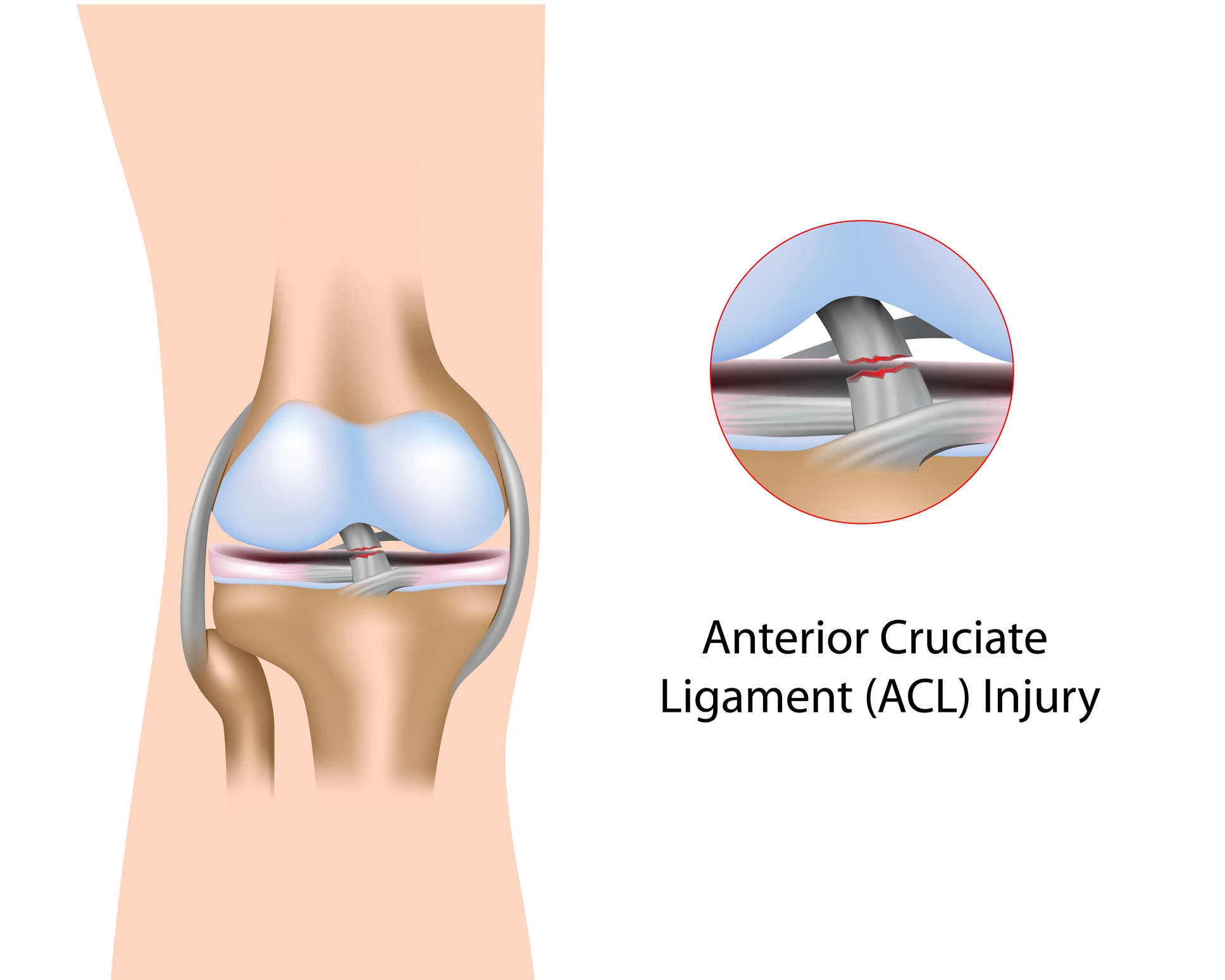 ACL Reconstruction
