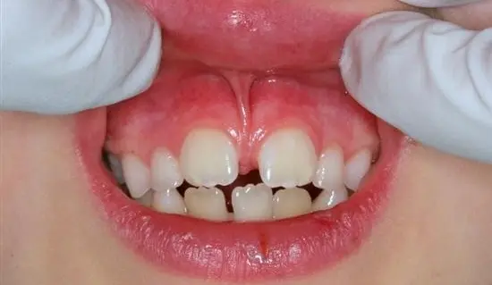 Laser Frenectomy