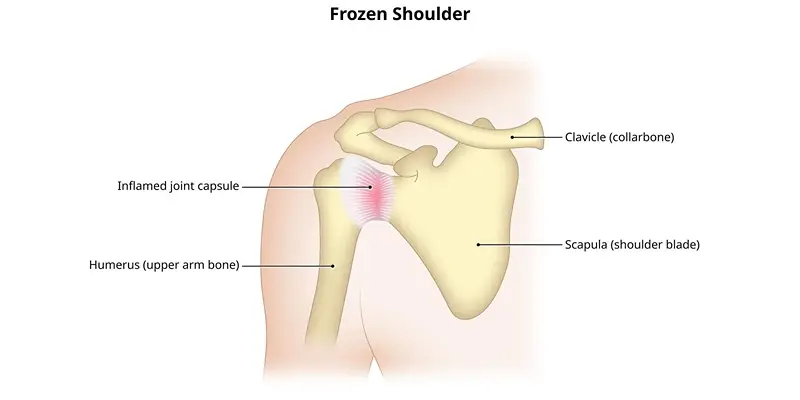 Frozen Shoulder