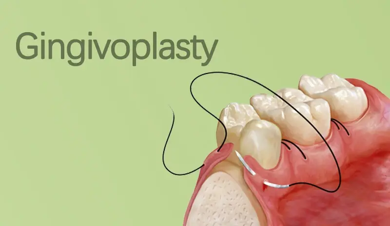 Gingivoplasty