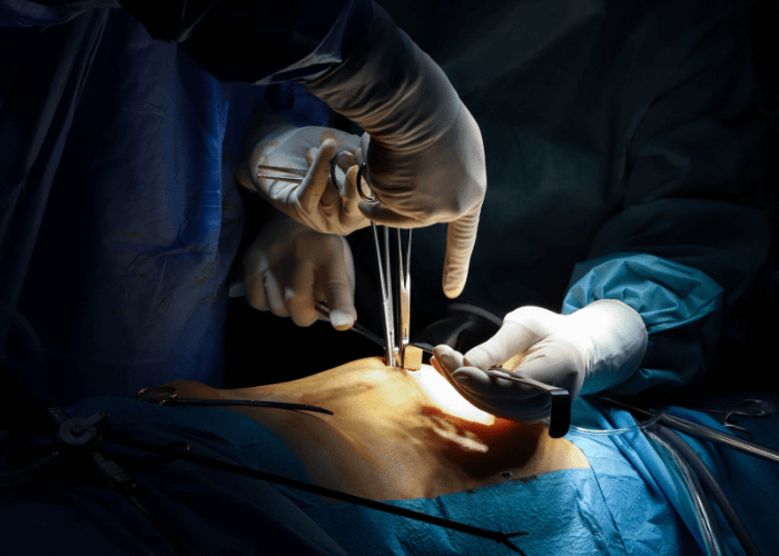 Hemorrhoids Surgery Dubai