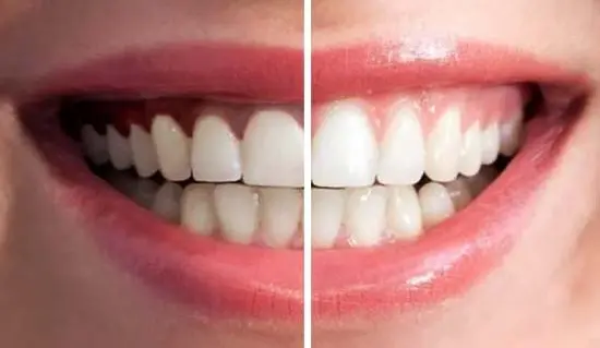 Gum Depigmentation