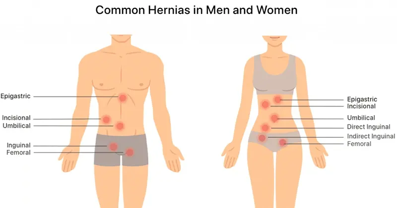 Hernia Surgery