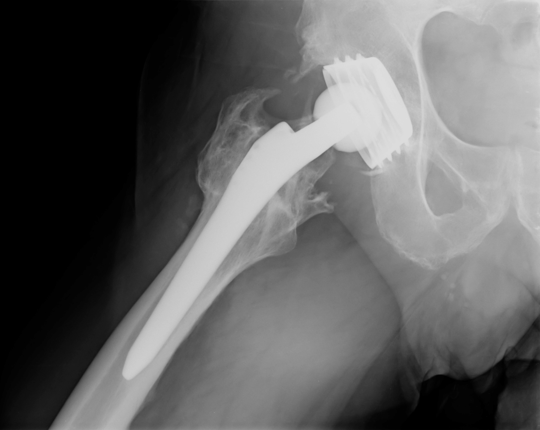 hip fracture