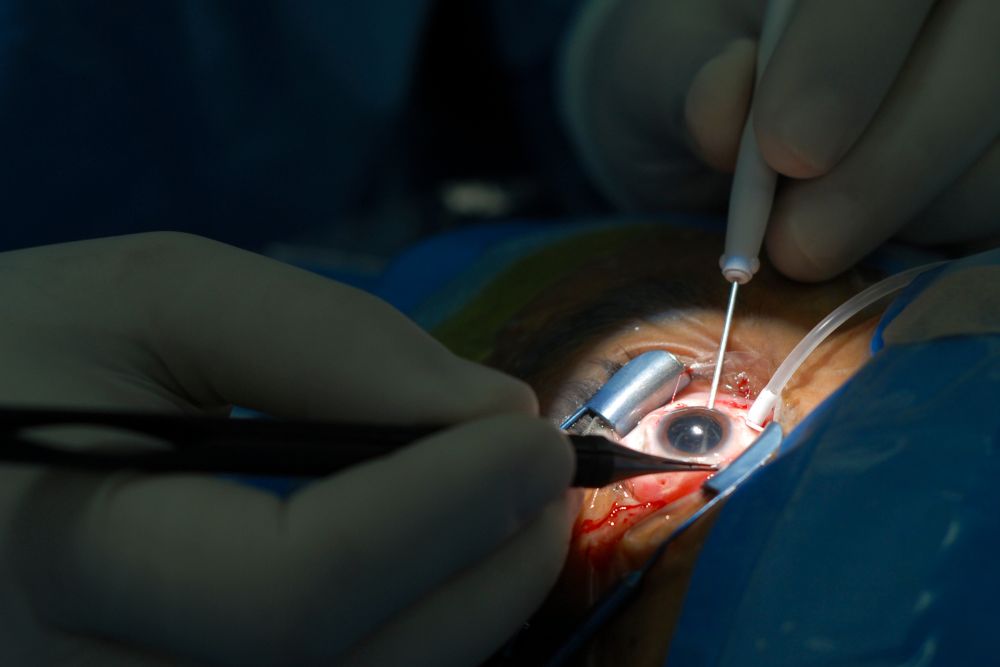 Trabeculectomy Cost Dubai