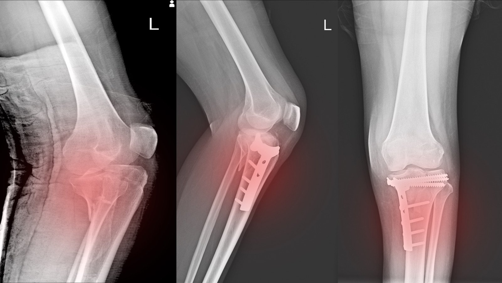 Knee Fracture