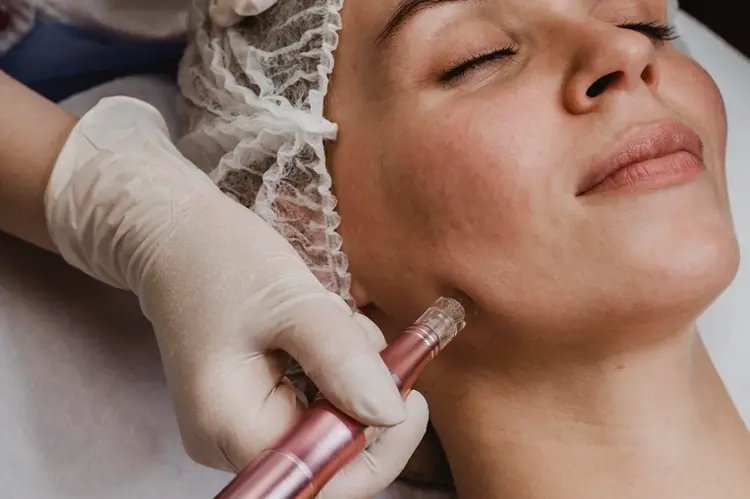 Laser Acne Scar Treatment Dubai