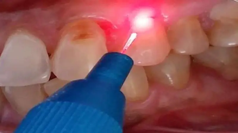 Dentine Hypersensitivity