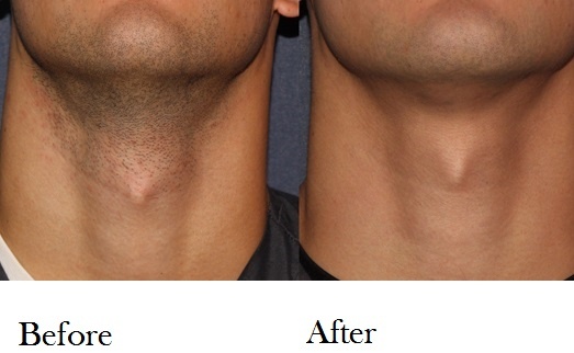 Laser Hair Removal