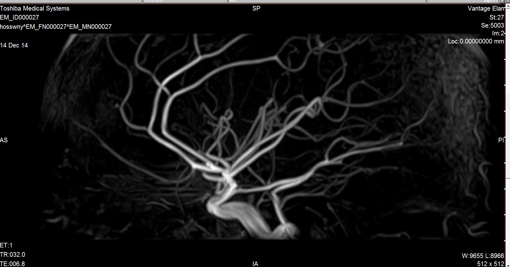 MRA Brain