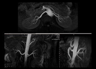 mra_renal_slide-1.jpg