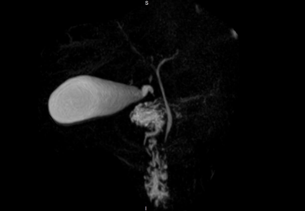 Magnetic resonance cholangiopancreatography (MRCP)