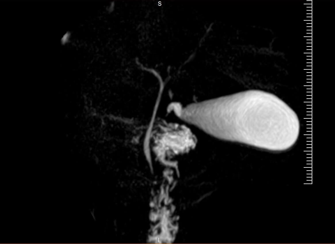 Magnetic resonance cholangiopancreatography (MRCP)