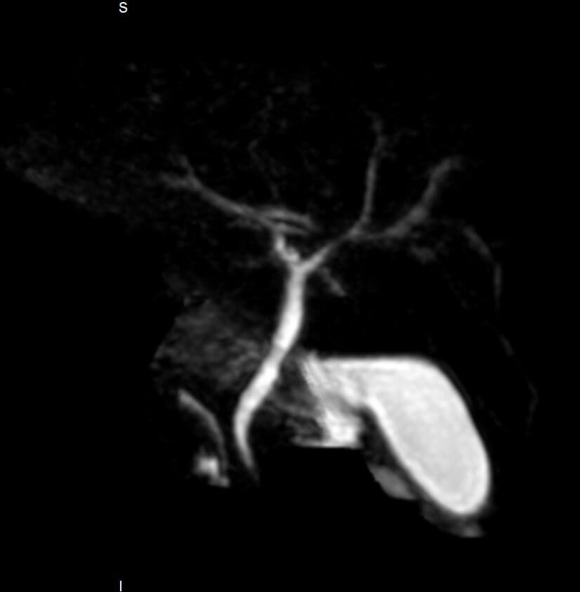 Magnetic resonance cholangiopancreatography (MRCP)