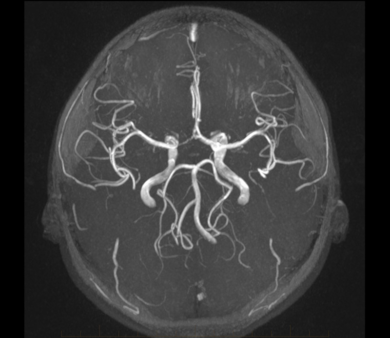 MRI Brain