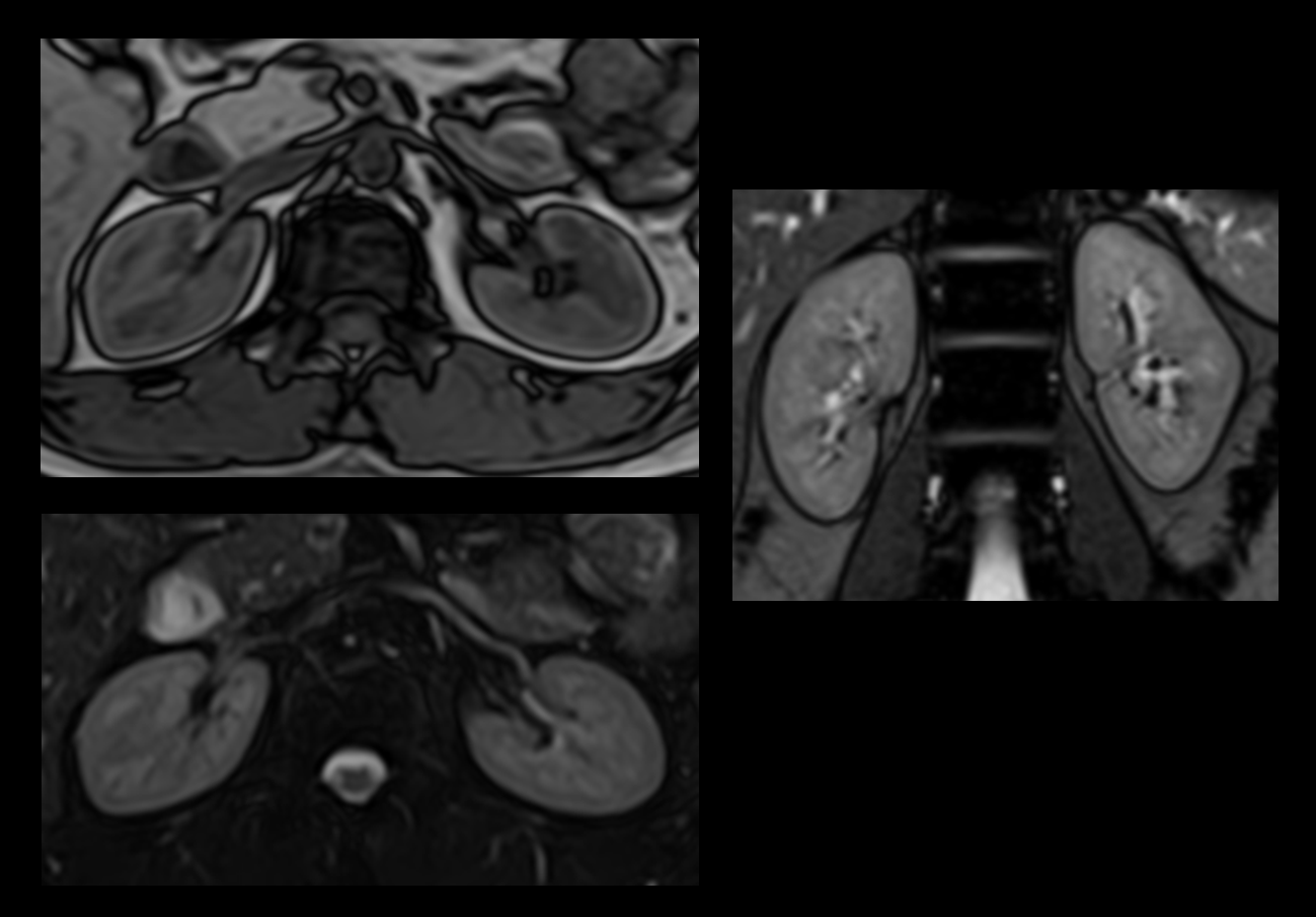 MRI Kidney