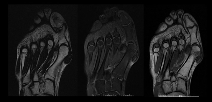 mri_slide_forefoot-1.jpg