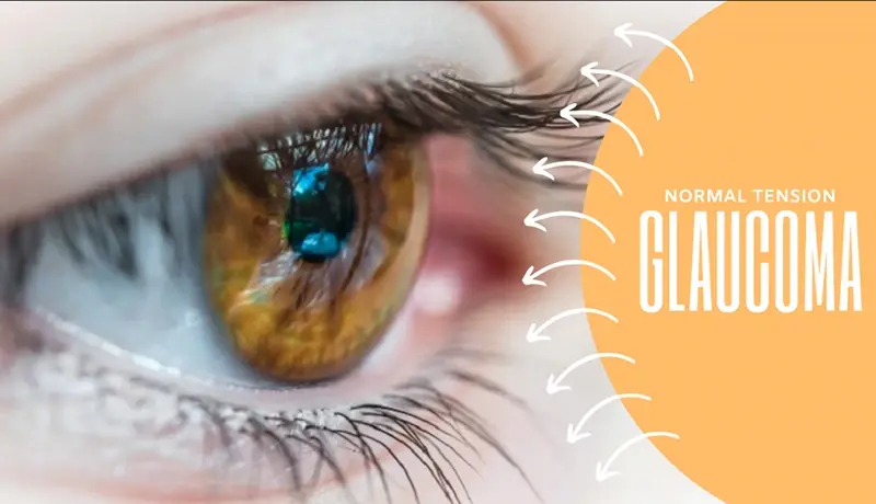 Normal Tension Glaucoma (Low Pressure)