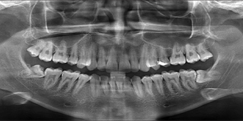 Dental Orthopantomogram (OPG)