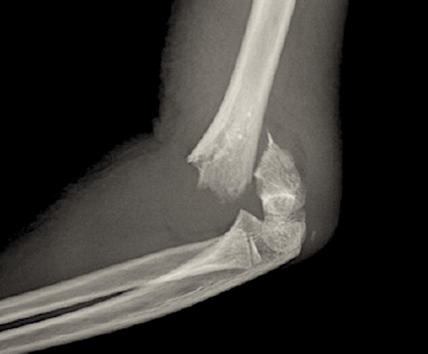 pediatric supracondylar fracture