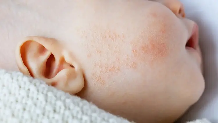 Pediatric Eczema Treatment Dubai