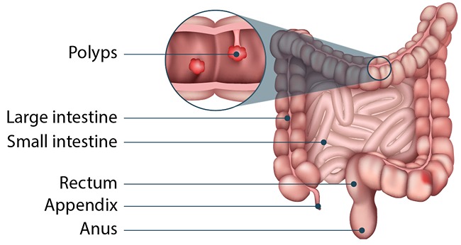 Colon Polyps: Why Are They Removed During Colonoscopy?