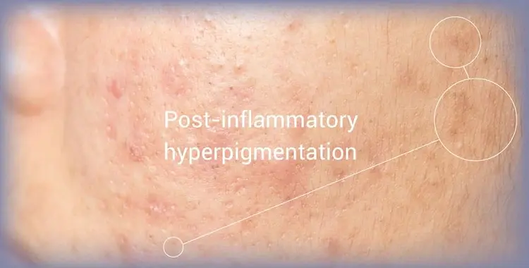 Post Inflammatory Hyperpigmentation Treatment dubai